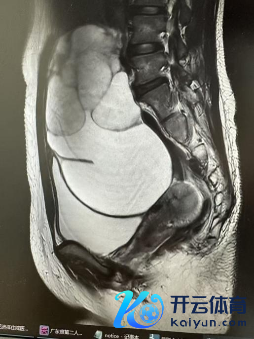 开云体育冉冉吸出囊液、完整剥除囊肿-开云(中国)Kaiyun·官方网站 登录入口